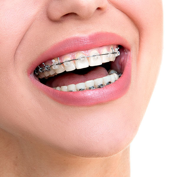 Metal Braces in Park Ridge | DiFranco Orthodontics